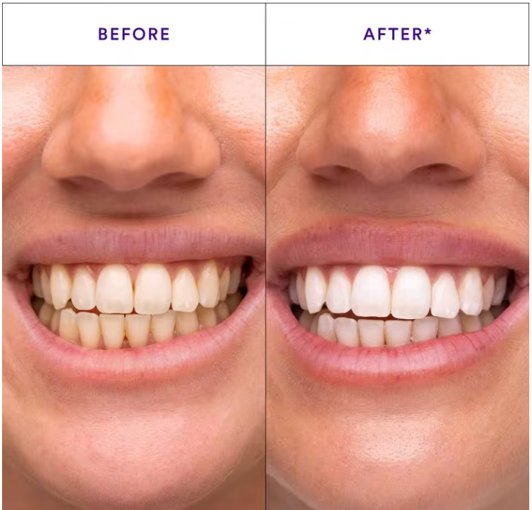 Le sourire éclatant que votre dentiste vous facture une fortune en 30 minutes chez vous