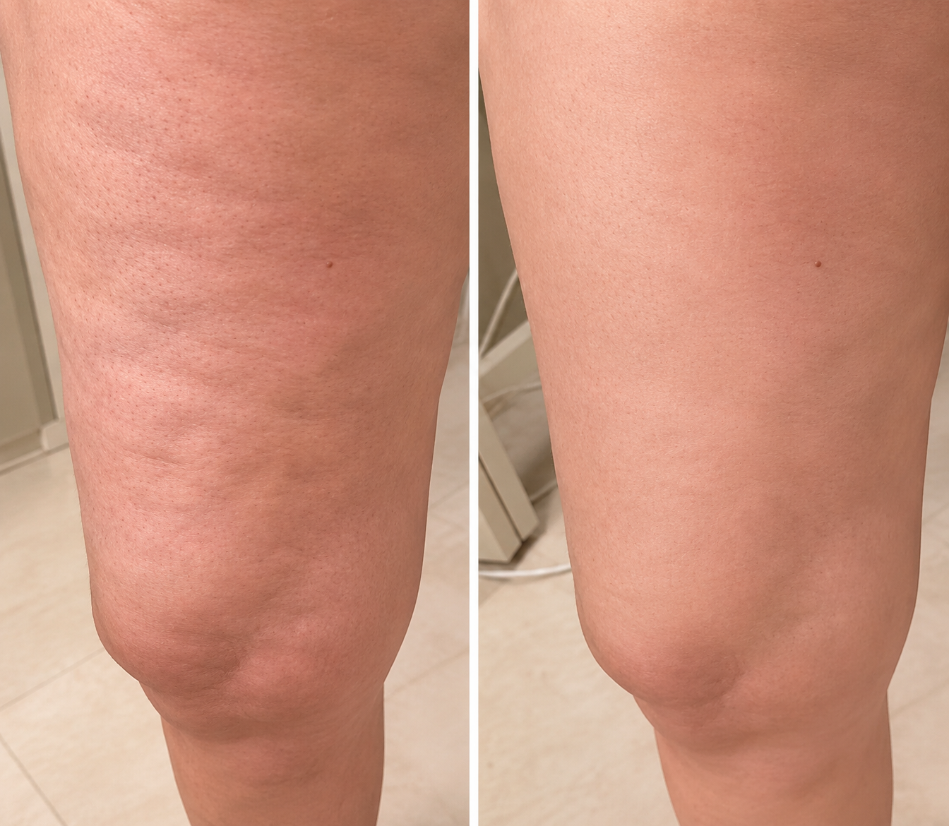 Straffendes Anti-Cellulite-Massageöl