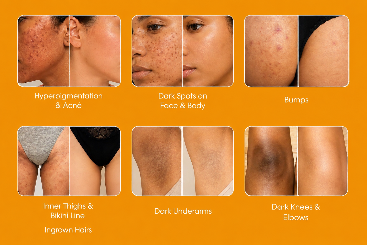 Taches & Hyperpigmentation