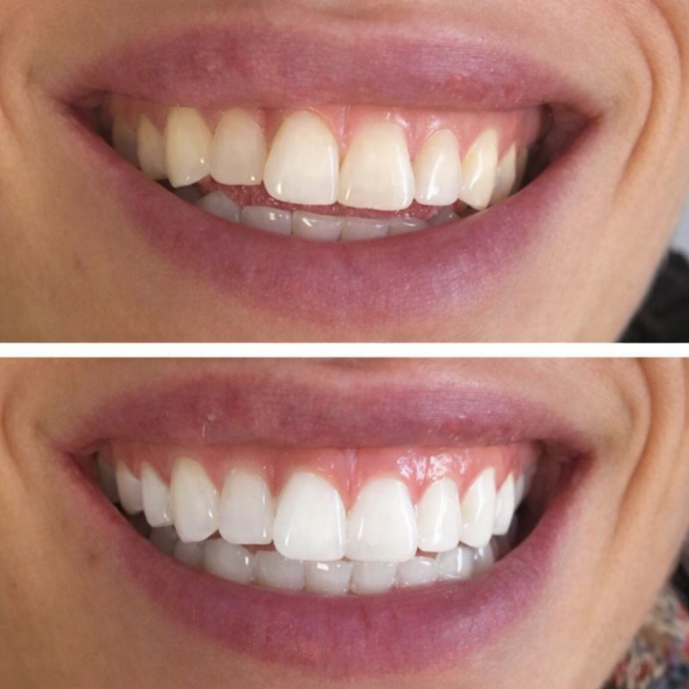 Sourire Éclat Express Bandes Sans Sensibilité