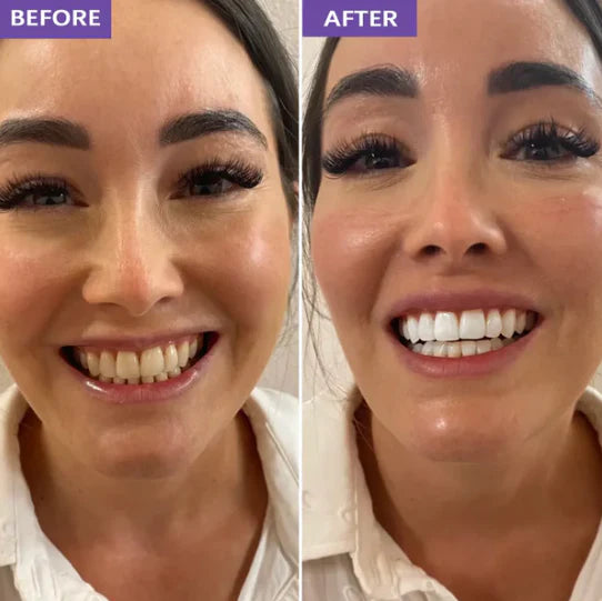 Le sourire éclatant que votre dentiste vous facture 500€ en 30 minutes chez vous